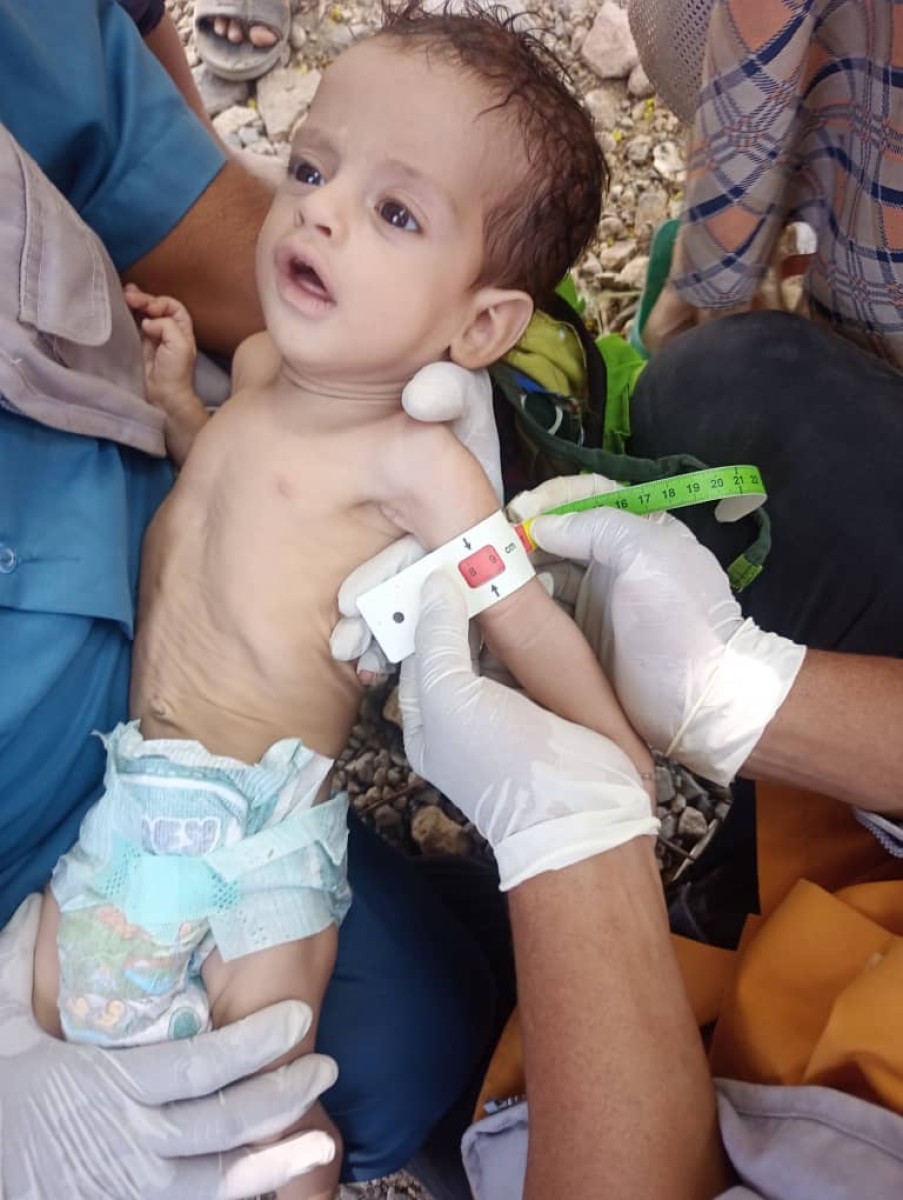 Yemeni children face the specter of malnutrition as the crisis in the country worsens