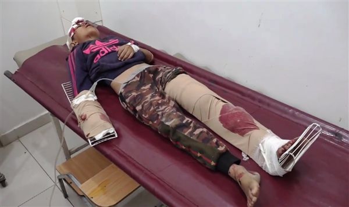 A child was injured by Houthi shell fragments south of Taiz