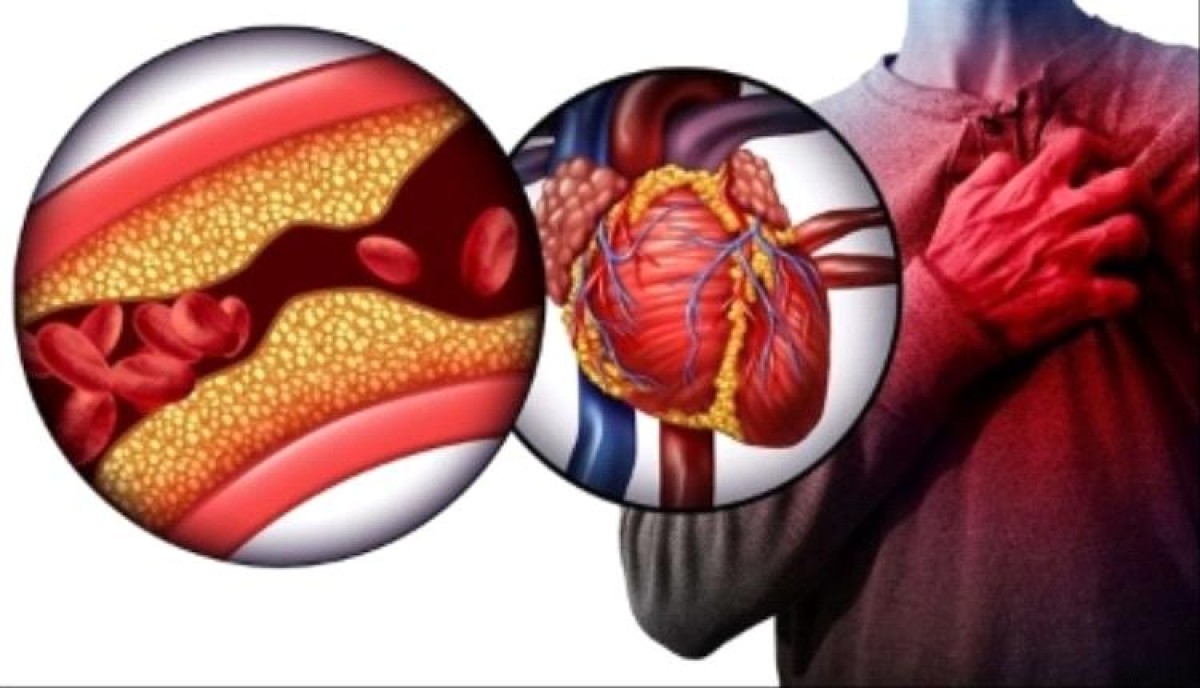 Study reveals the relationship between Alzheimer's and heart disease..