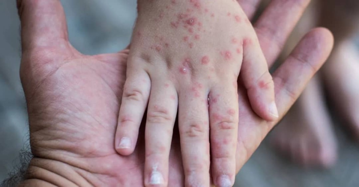 Chickenpox.. A medical team explains its spread in Nishtun Al-Mahra