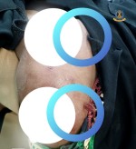 إصابة امرأة برصاصة قناص حوثي شمال غربي الضالع