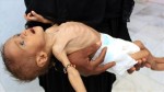 اليونيسف تطلق مبادرة تغذوية لتسريع الحد من نقص التغذية في اليمن
